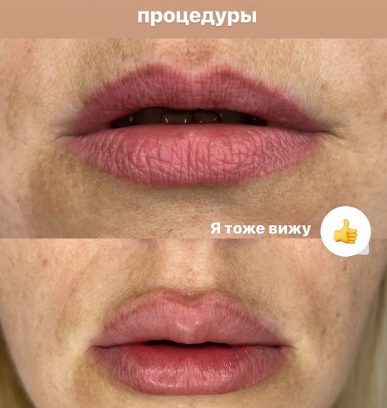 Удаление перманента губ